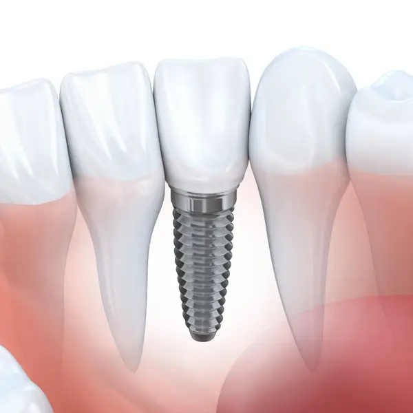 dental implant