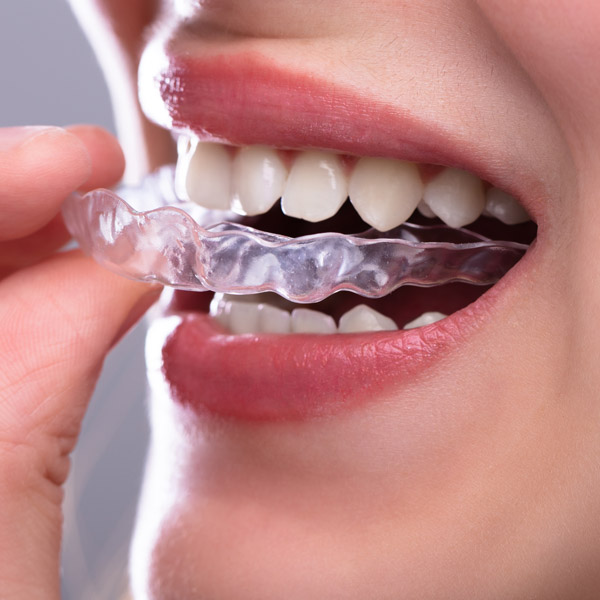 Woman putting on clear aligner
