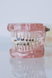 Photo by cottonbro: https://www.pexels.com/photo/close-up-shot-of-dentures-with-braces-6502309/